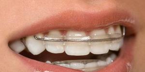 Placche e altri dispositivi rimovibili per raddrizzare i denti